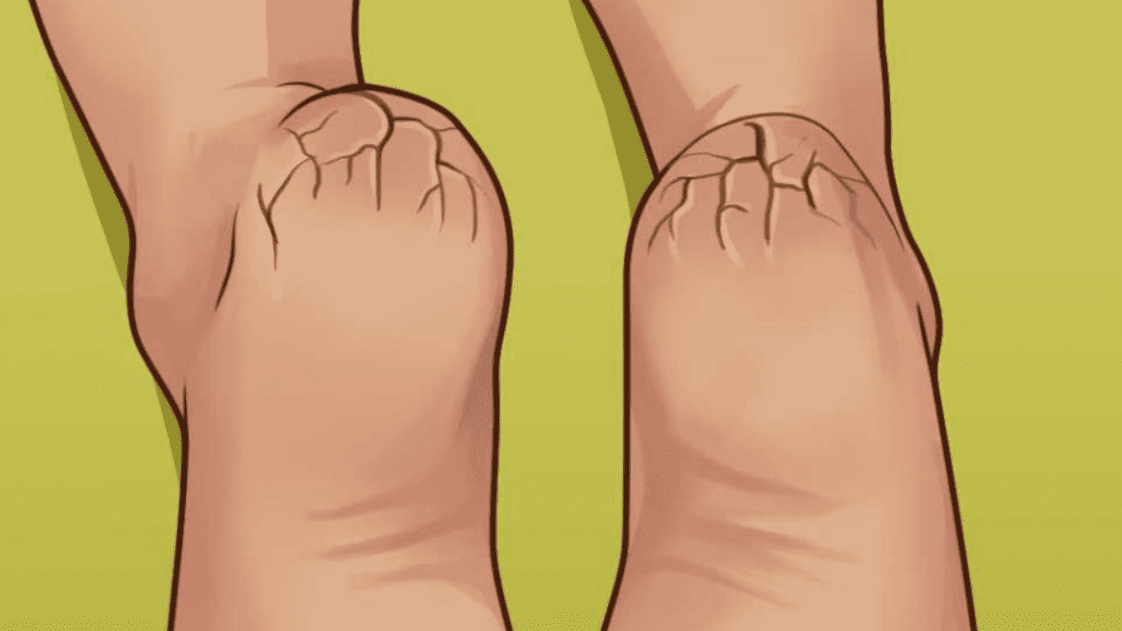 8 natural tips for dry and damaged feet GRANDMA’S TRICKS